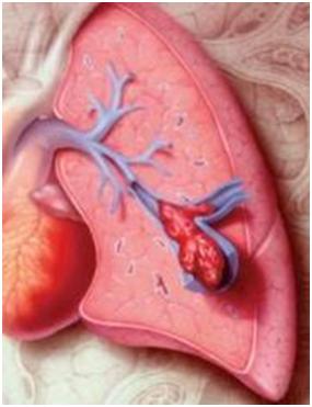 Hiểm họa do nghẽn mạch phổi 